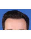 After Hair Transplant&nbsp;Hairlines
